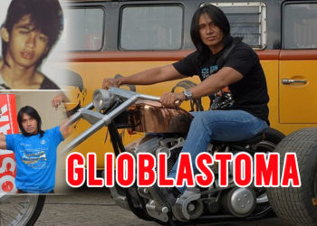 Penyakit Kanker Otak