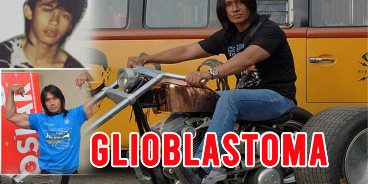 Penyakit Kanker Otak