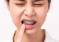 Mengelupas Kulit Bibir