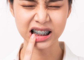 Mengelupas Kulit Bibir