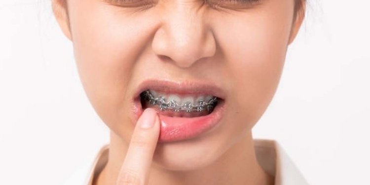 Mengelupas Kulit Bibir