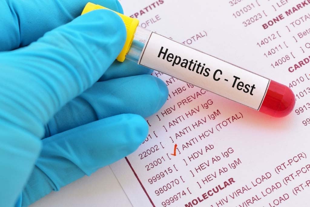 Gejala Penyakit Hepatitis